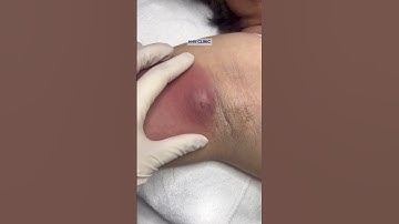 Large, painful, inflamed abscess.