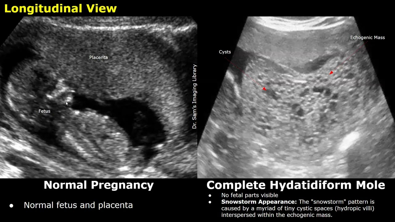 Obstetric Ultrasound Normal Vs Complete Hydatidiform Mole Images | Molar Pregnancy USG Cases