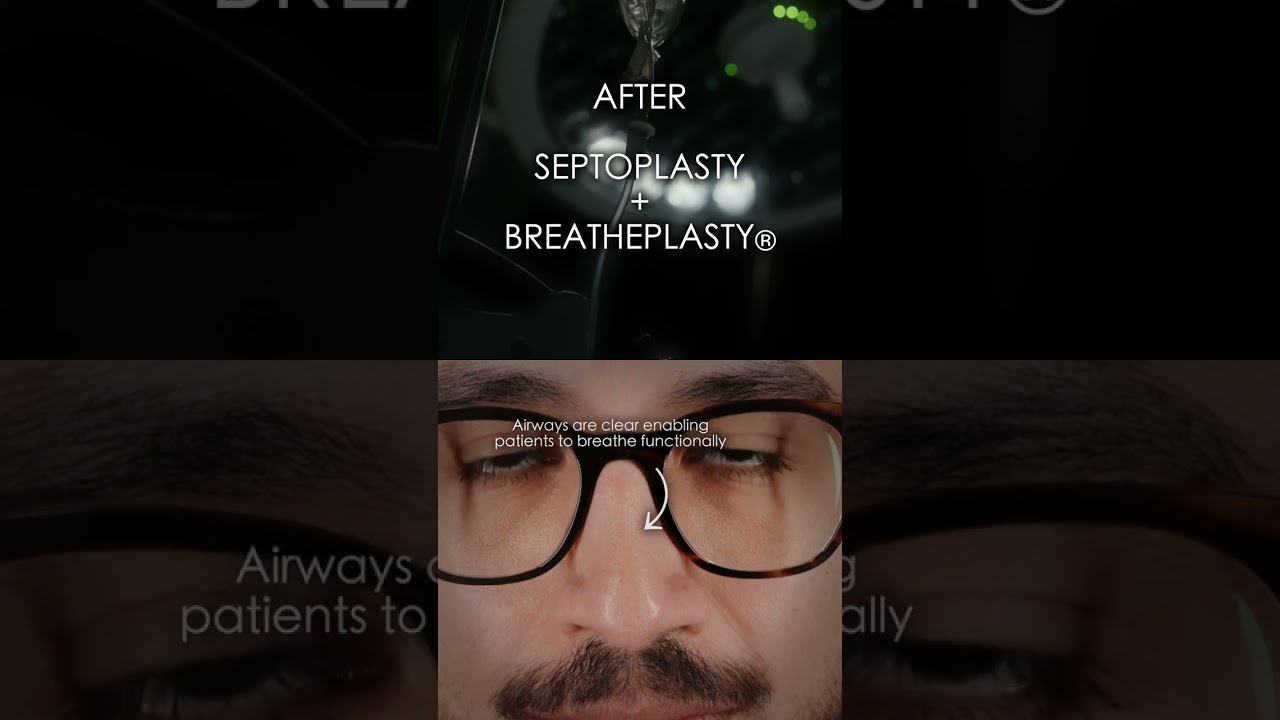 SEPTOPLASTY BEFORE AFTER 