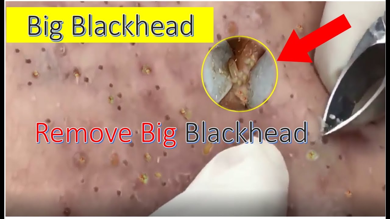 Very Big Blackhead Remove, Most satisfying video ever YouTube
