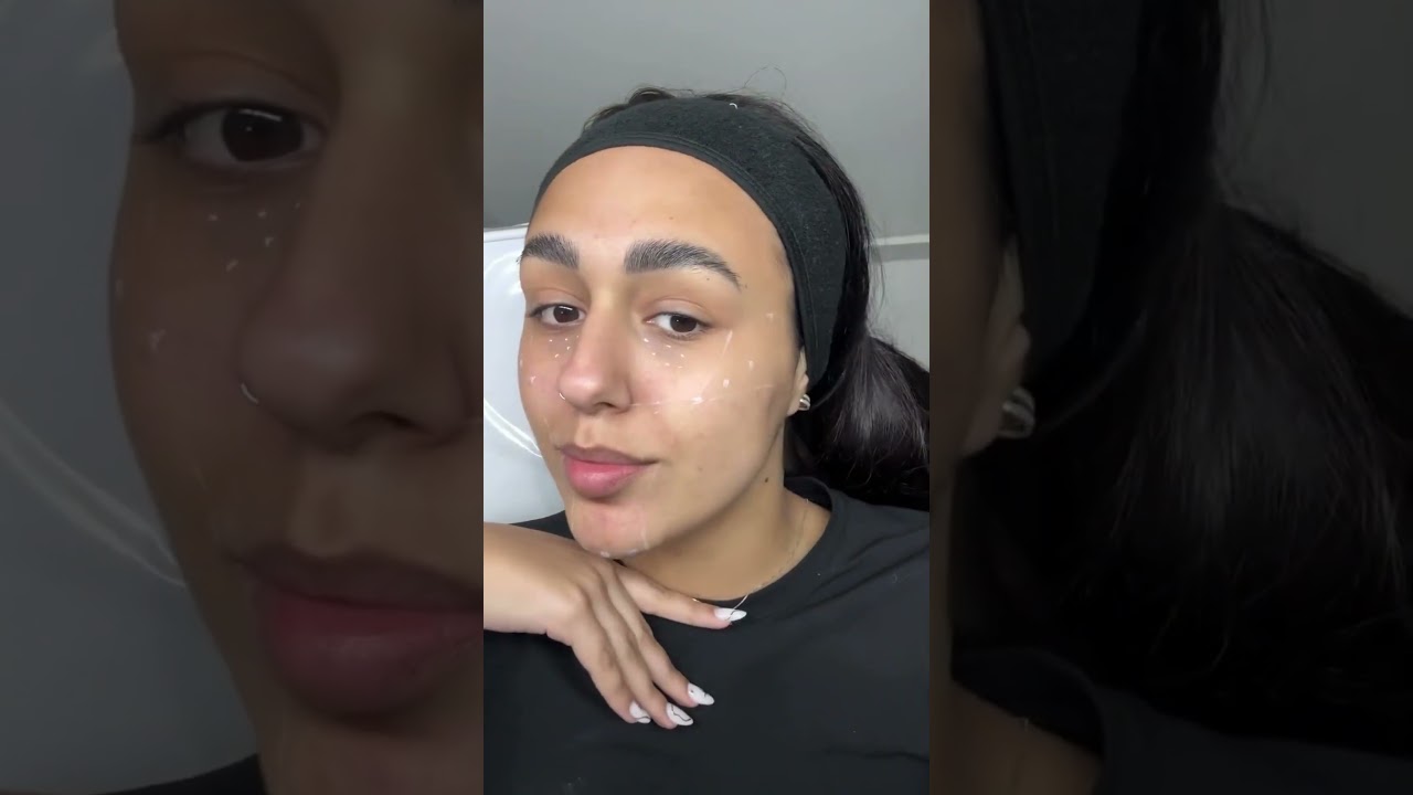 Harmonização facial no Centro de São José dos Pinhais | Marafigo Clínica