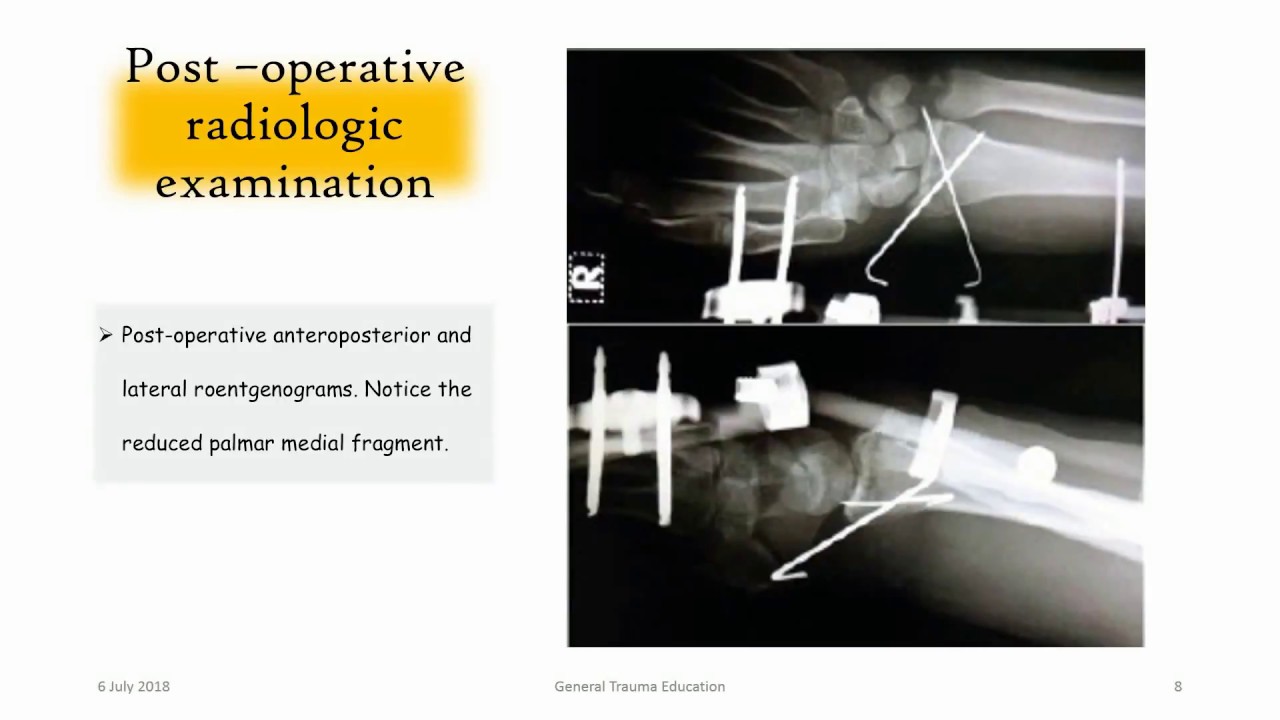 Distal Radius Articular Multifragmentary Fracture / El bilek eklem içi parçalı kırığı