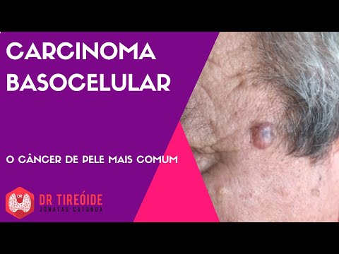 Vídeo: O carcinoma espinocelular dói?