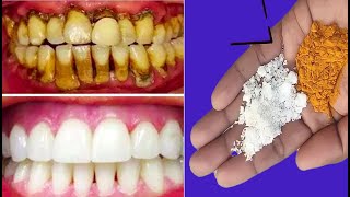 Sadece 2 Dakikada Diş Beyazlatma | Diş Tartarı Ve lekeli Dişler İçin Anında Çözüm - İnci Gibi Dişler