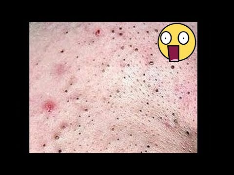 Cystic Acne, Pimples And Blackheads Extraction Acne Treatment On Face!!! - Part 