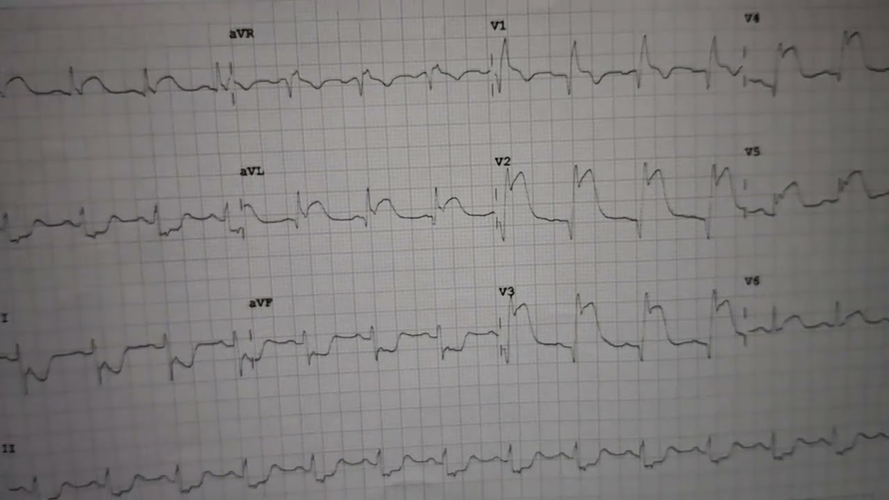 Myocardial Infraction ECG changes