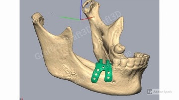 Make the Implantation Procedure easy using D2P software