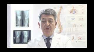 Artroplastia de rodilla