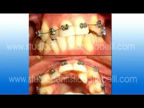 Caso Clinico Ortodontico Dott. Stefano Altobelli e...