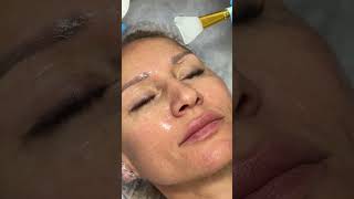 RF - лифтинг #vtop #красотаназдоровье #beautyful #лифтингмосква #доктор #косметология