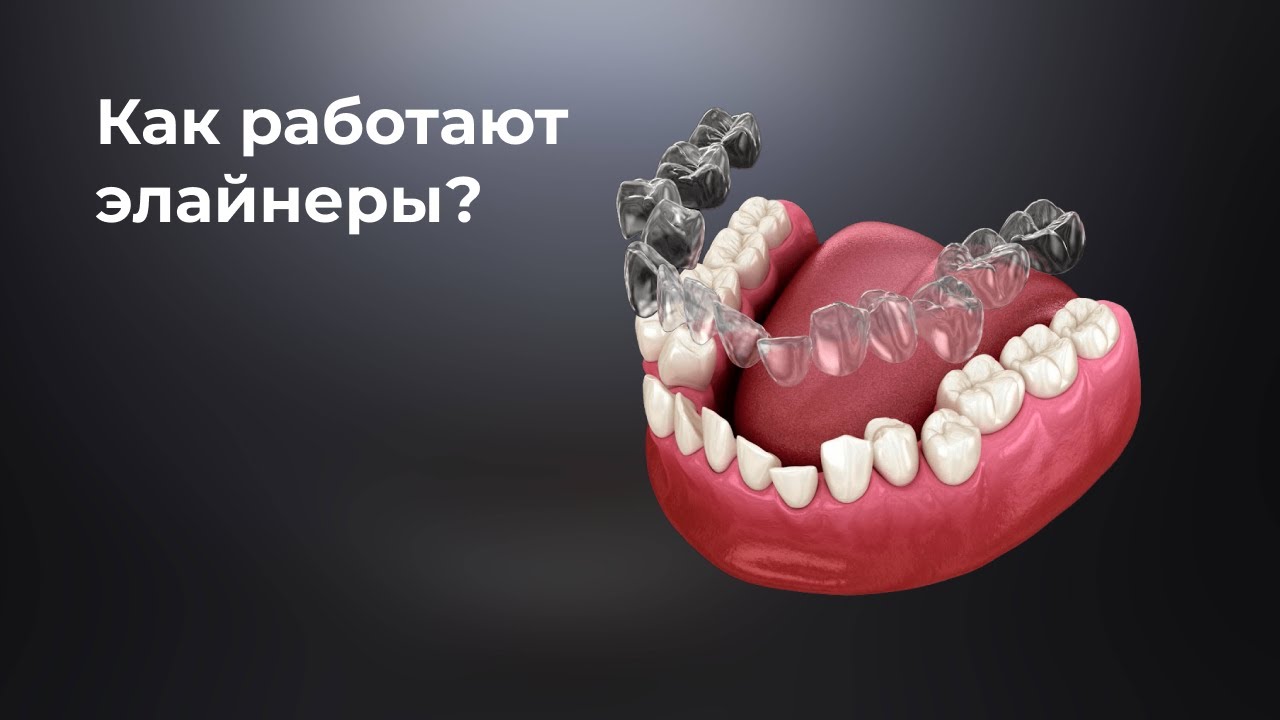 Как работают элайнеры?