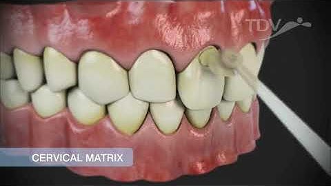 Cervical Matrix   TDV Dental