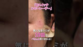 徳島 シミ治療 | 赤池クリニック｜肝斑・そばかす・シミ取りレーザー