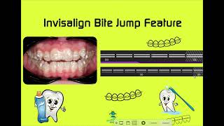 Invisalign Bite Jump Feature
