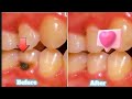 Gum Side Tooth Cavity Treatment| Light Cure Composite Filling #dentist #shorts #youtubeshorts #teeth