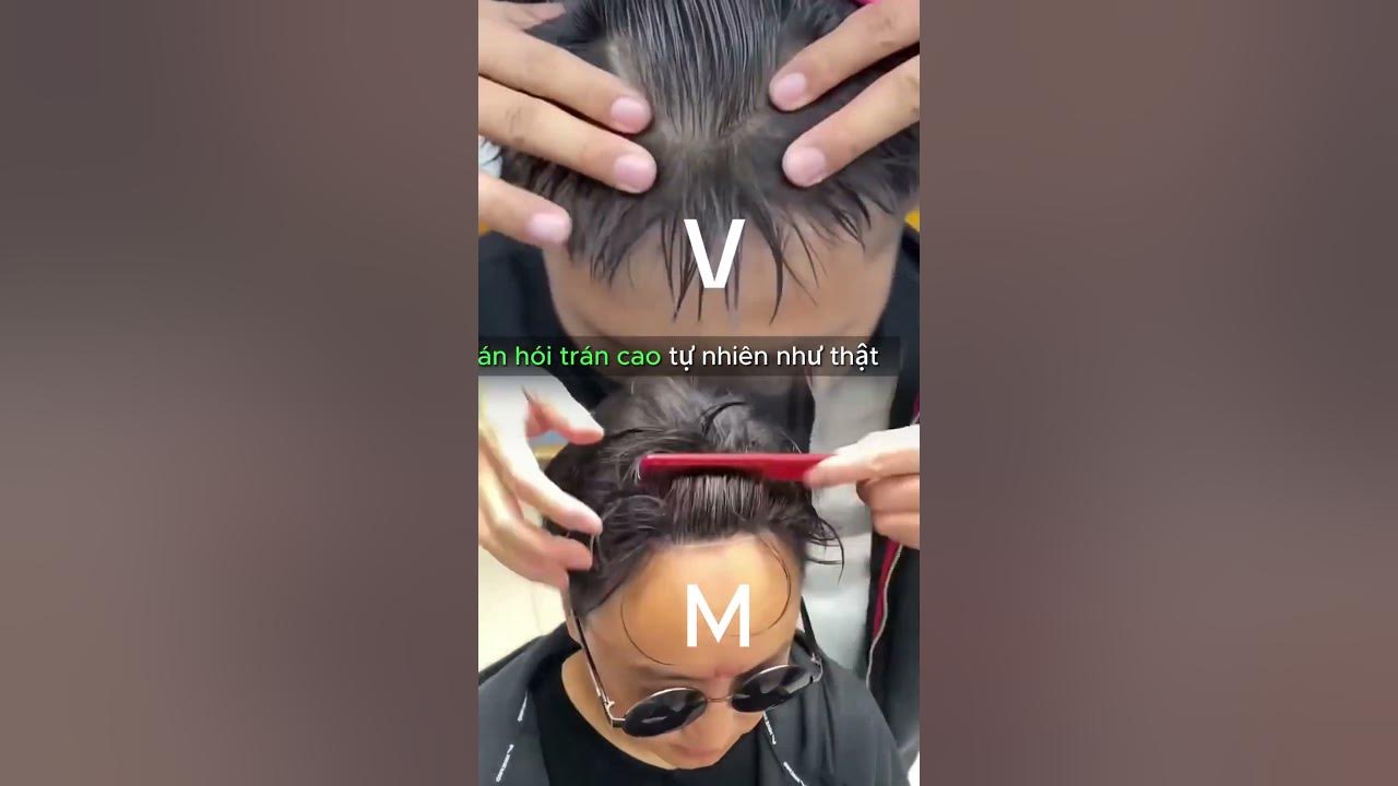 Trán cao hình chữ M hay chữ V đều có thể khắc phục được bằng miếng ...