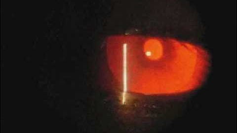 Ophthalmology - Albinism and the eye