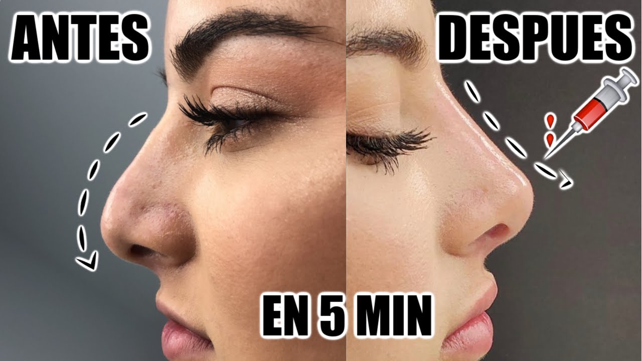 ME INYECTE ACIDO HIALURONICO! La rinomodelacion tiene efectos