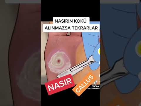 Ayak nasrının kökü