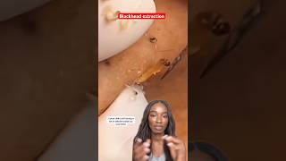 Chemist Explains SEBACEOUS FILAMENT &amp; BLACKHEAD REMOVAL on skin