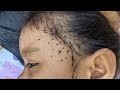 Remove all hundred head lice  pick out all those head lice from hair