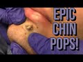 Chin Pimples And Zits Facial Acne 2020 The BEST Chin Extractions Chin Pimples And Zits Facial Acne 2020 The BEST Chin Extractions