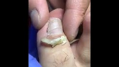 Satisfying Ingrown Toenail Removal-7-2018