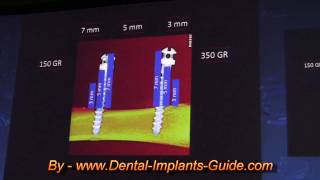 Osseointegration - A complication for orthodontic implants? Part 2 by dentalimplantsworld 741 views 12 years ago 9 minutes, 46 seconds