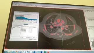 DORV segmentation time lapse