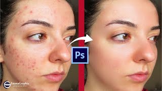 How to Remove Pimples, Blemishes, Wrinkles and Acne Quickly in Photoshop | Step by step Tutorial screenshot 4