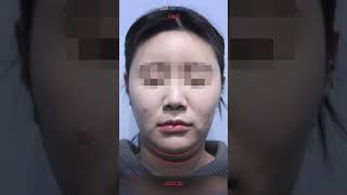 슈링크유니버스로 브이라인 얼굴 만드는거 어렵지 않아요