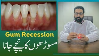 What is gum recession ? | Can gums grow back ? | @ateeqdentalcare screenshot 3