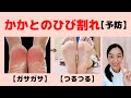 【簡単】かかとのひび割れを★予防する３つの方法(^0^)b 【大阪府茨木市の女性・美容鍼灸・整体師が教えます。】