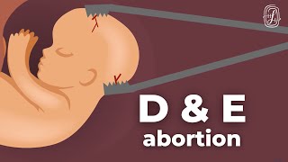 D&E Abortion (Dilation and Evacuation)