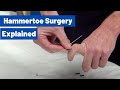 Hammertoe Surgery Explained by Dr. Moore (Using an 