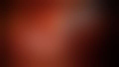 17.172URO Robotic Assisted Laparoscopic Pyelolithotomy for Treatment of Large Renal Stone...