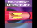 Атерэктомия сосудов сердца #сердце #кардиолог #атеросклероз #shorts