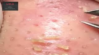 Most Relaxing, Satisfying, Enjoyable Acne Removal With Tweezer 12 Medley Stress Reliever