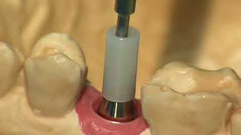 Single mandible posterior tooth Angled abutment