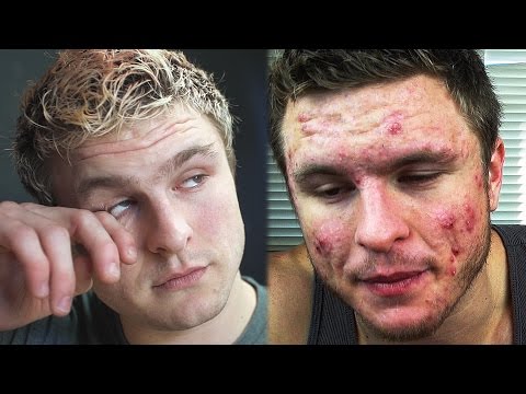 The Worst Day of My Life (MY ACNE STORY)