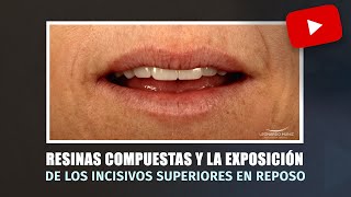 Resinas compuestas y la exposición de los incisivos superiores en reposo