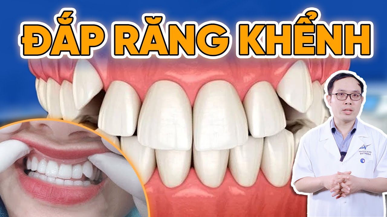 Outline Video Nên Đắp Răng Khểnh Bằng Composite Hay Bọc Sứ Răng Khểnh? Lắng Nghe Giải Pháp Từ Chuyên Gia