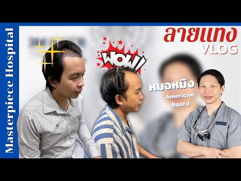 รีวิวปลูกผม อย่างละเอียด เทคนิค FUT | ลายแทง VLOG