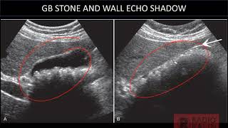 USG GALLBLADDER (CALCULUS , WALL ECHO SHADOW,PORCELAIN GB) screenshot 3