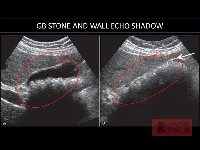 Wall-echo-shadow sign (ultrasound)