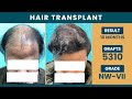 Best Hair Transplant Results in Delhi | Hair Transplant cost in Delhi | 4200 Grafts | SkinQure