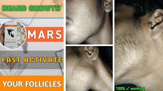 BEARD GROWTH || अपने दाढ़ी के Follicles को तेजी से Active कैसे करें Fast grow your beard