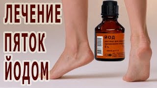 ★ЛЕЧЕНИЕ ПЯТОК ЙОДОМ. Сетка из ЙОДА - отличное средство от ПЯТОЧНОЙ ШПОРЫ. ★ЛЕЧЕНИЕ ПЯТОК ЙОДОМ. Сетка из ЙОДА - отличное средство от ПЯТОЧНОЙ ШПОРЫ.