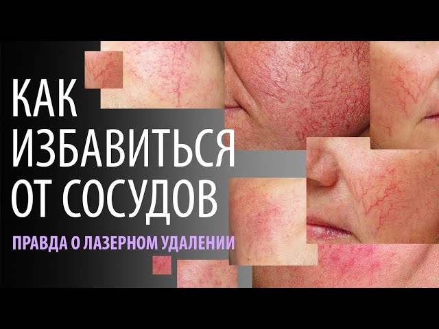 Как избавиться от сосудов на лице?