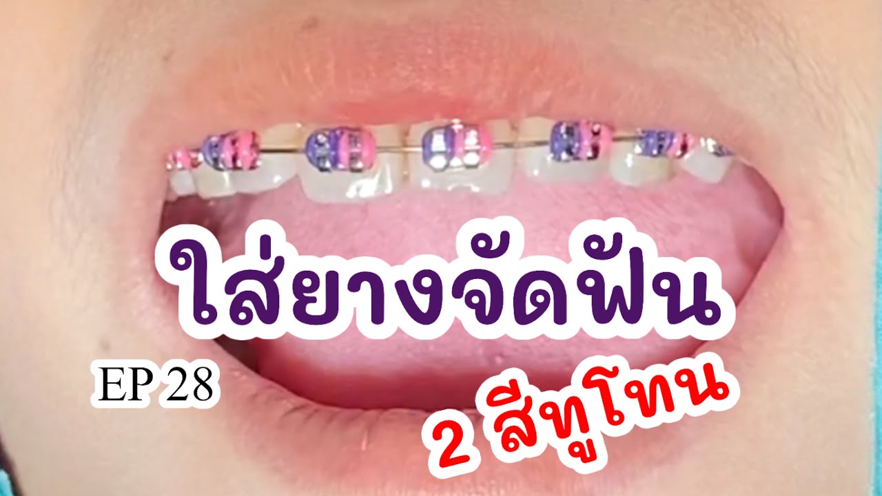 Ep28. ใส่ยางจัดฟัน 2 สีทูโทน - Youtube